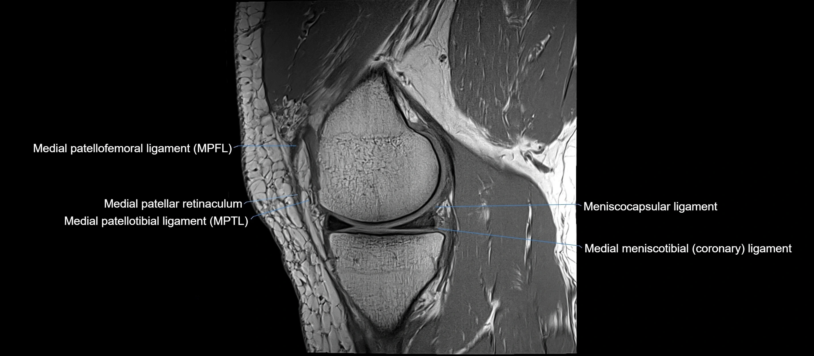 MRI sagittal  ligaments cross sectional anatomy 3T  radiology  image-img-00001-00016.webp